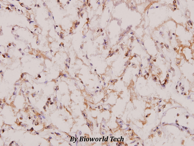 Immunohistochemistry (IHC) analyzes of Topo IIβ (A32) pAb in paraffin-embedded human lung carcinoma tissue at 1:100.