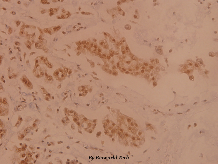 Immunohistochemistry (IHC) analyzes of TXNRD2 (S501) pAb in paraffin-embedded human breast carcinoma tissue at 1:100.