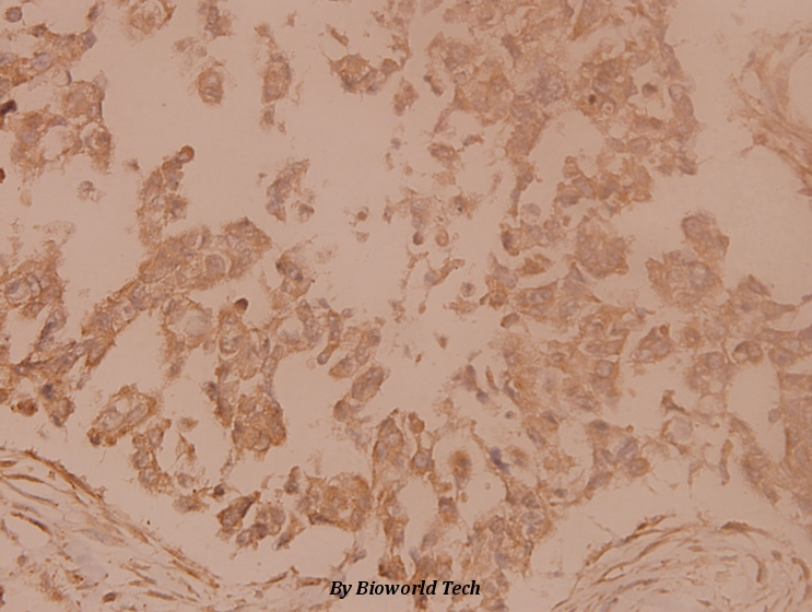 Immunohistochemistry (IHC) analyzes of Tubulin γ (F414) pAb in paraffin-embedded human breast carcinoma tissue at 1:100.