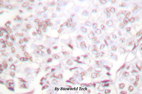 Immunohistochemistry (IHC) analyzes of XRCC2 (F240) pAb in paraffin-embedded human lung carcinoma tissue.