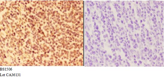 Immunohistochemistry (IHC) analyzes of ALOX5 (E267) pAb in paraffin-embedded human tonsil carcinoma tissue at 1:50,showing cytoplasm,nucleus and nucleus membrane staining.Negative control (the right)Using PBS instead of primary antibody, secondary antibody is Goat Anti-Rabbit IgG-biotin followed by avidin-peroxidase.