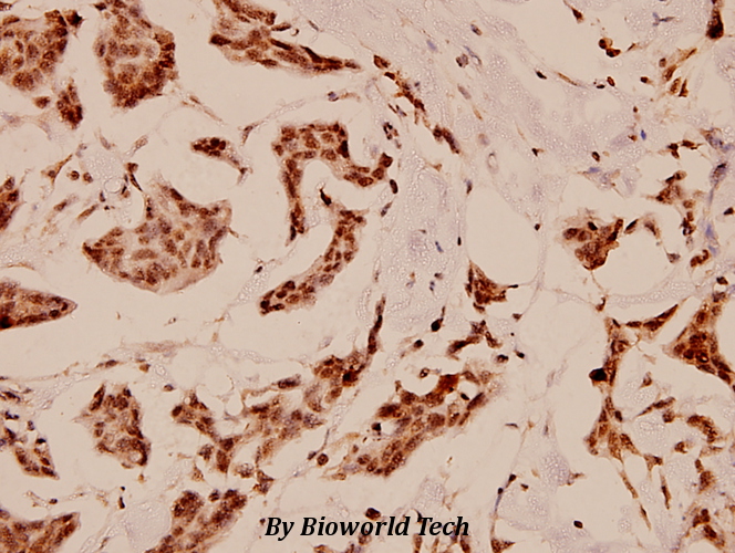 Immunohistochemistry (IHC) analyzes of C/EBP-ε (K70) pAb in paraffin-embedded human breast carcinoma tissue at 1:100.