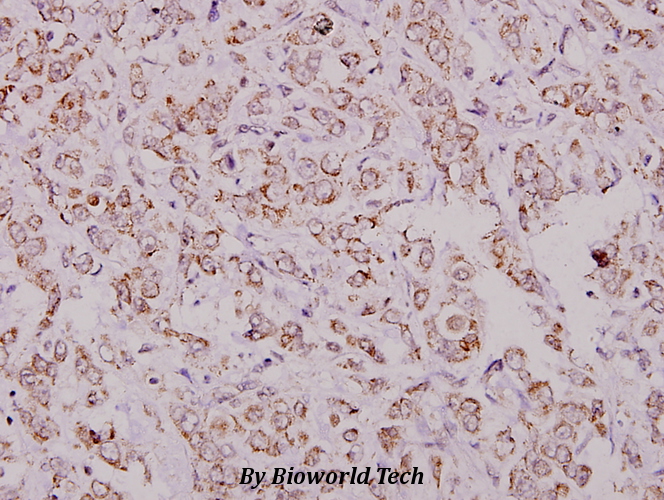 Immunohistochemistry (IHC) analyzes of eIF4G (Q1103) pAb in paraffin-embedded human breast carcinoma tissue at 1:100.