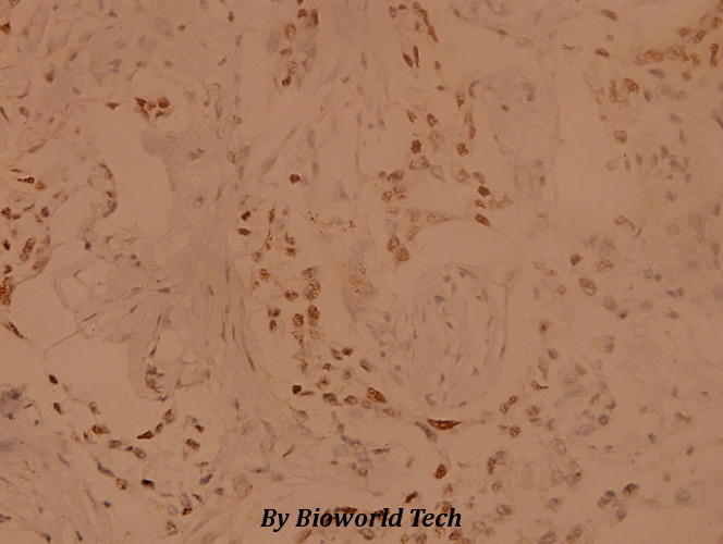 Immunohistochemistry (IHC) analyzes of MYPT1 (R847) pAb in paraffin-embedded human breast carcinoma tissue at 1:100.
