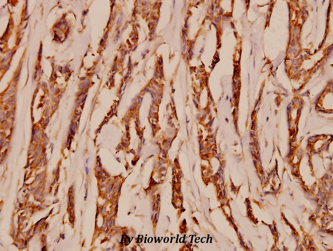 Immunohistochemistry (IHC) analyzes of NMDAζ1 (S885) pAb in paraffin-embedded human breast carcinoma tissue at 1:100.