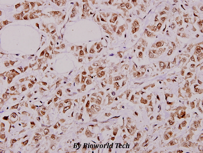 Immunohistochemistry (IHC) analyzes of PFKFB2 (P479) pAb in paraffin-embedded human breast carcinoma tissue at 1:100.