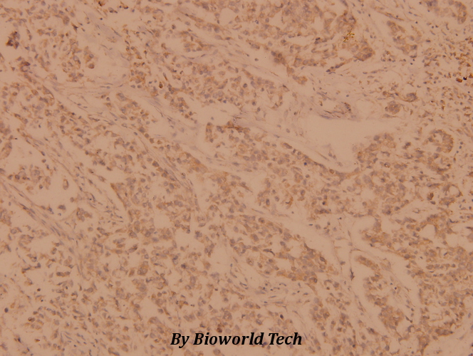 Immunohistochemistry (IHC) analyzes of PLC γ2 (N1211) pAb in paraffin-embedded human breast carcinoma tissue at 1:100.
