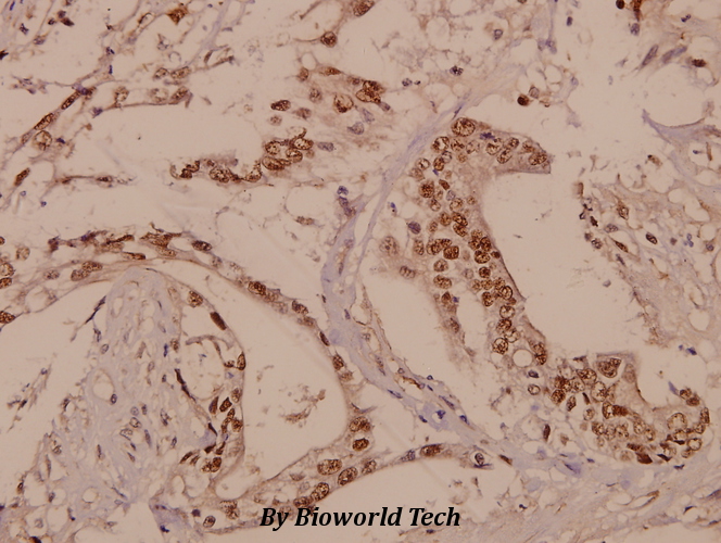 Immunohistochemistry (IHC) analyzes of Rhodopsin (L328) pAb in paraffin-embedded human colorectal carcinoma tissue at 1:50.