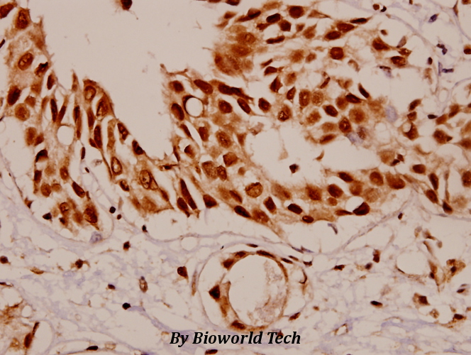 Immunohistochemistry (IHC) analyzes of SF1 (P76) pAb in paraffin-embedded human breast carcinoma tissue at 1:50.