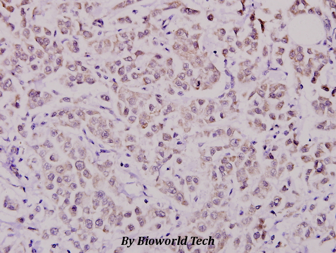 Immunohistochemistry (IHC) analyzes of WAVE1 (I119) pAb in paraffin-embedded human breast carcinoma tissue at 1:100.
