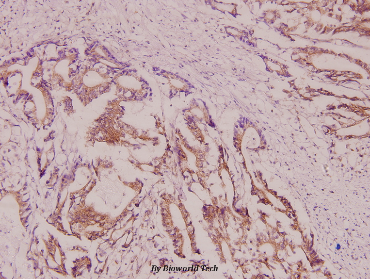 Immunohistochemistry (IHC) analyzes of DAPK2 (R314) pAb in paraffin-embedded human colorectal cancer carcinoma tissue at 1:100.
