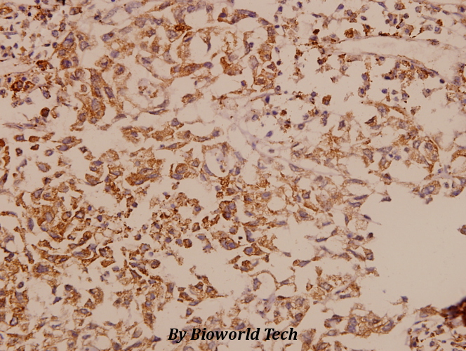 Immunohistochemistry (IHC) analyzes of DDX3 (L318) pAb in paraffin-embedded human breast carcinoma tissue at 1:50.