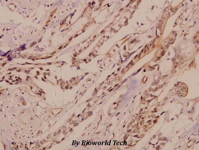 Immunohistochemistry (IHC) analyzes of GluR4 (K858) pAb in paraffin-embedded human colorectal carcinoma tissue at 1:50.