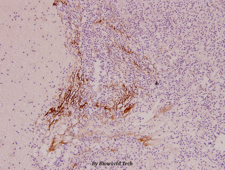 Immunohistochemistry (IHC) analyzes of IL-9R (L514) pAb in paraffin-embedded human liver carcinoma tissue at 1:100.