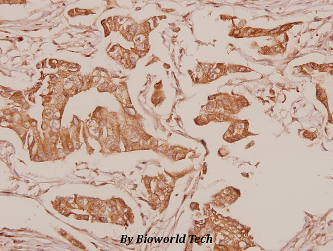 Immunohistochemistry (IHC) analyzes of MgcRacGAP (L383) pAb in paraffin-embedded human breast carcinoma tissue at 1:50.