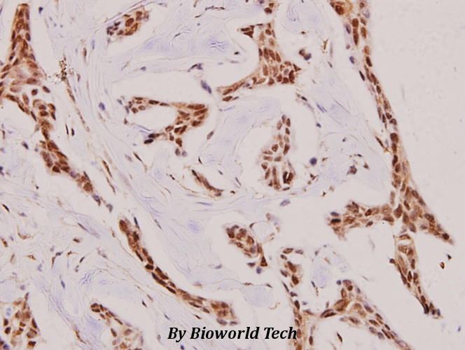 Immunohistochemistry (IHC) analyzes of NIFK (D229) pAb in paraffin-embedded human breast carcinoma tissue at 1:100.