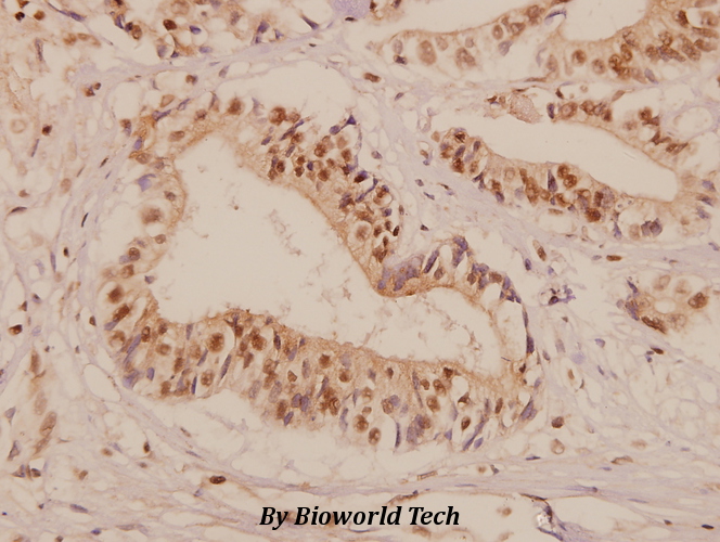 Immunohistochemistry (IHC) analyzes of GAS3 (A142) pAb in paraffin-embedded human colorectal carcinoma tissue at 1:50.