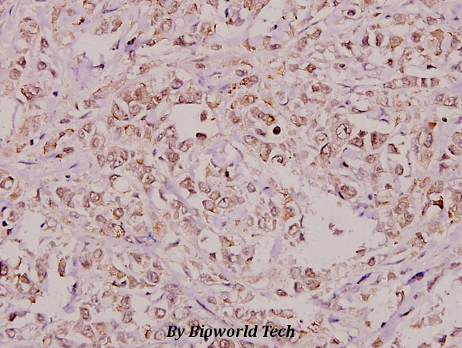 Immunohistochemistry (IHC) analyzes of RPA2 (A17) pAb in paraffin-embedded human breast carcinoma tissue at 1:100.
