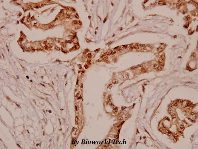Immunohistochemistry (IHC) analyzes of TPH1 (K54) pAb in paraffin-embedded human breast carcinoma tissue at 1:50.
