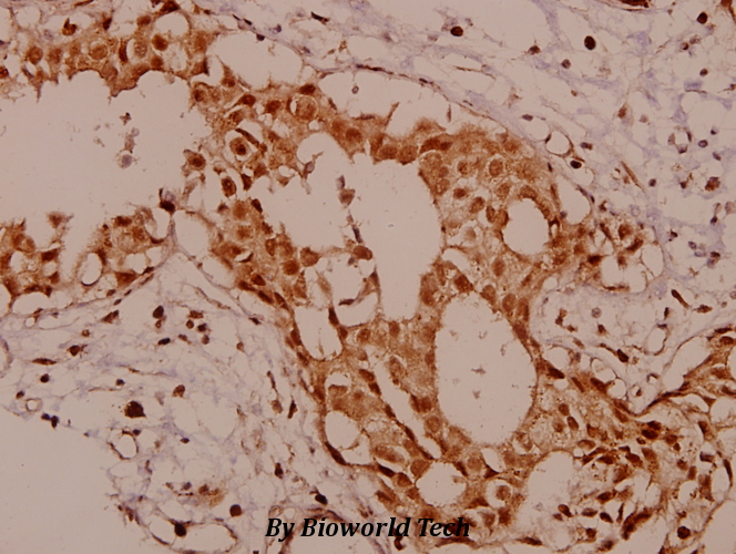 Immunohistochemistry (IHC) analyzes of KSR (R386) pAb in paraffin-embedded human breast carcinoma tissue at 1:50.