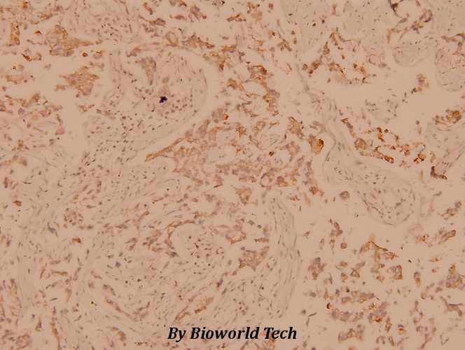 Immunohistochemistry (IHC) analyzes of PLC γ1 (G765) pAb in paraffin-embedded human breast carcinoma tissue at 1:100.