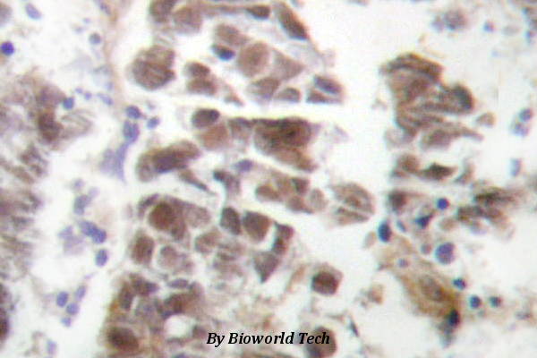 Immunohistochemistry (IHC) analyzes of GATA4 (P101) pAb in paraffin-embedded human lung carcinoma tissue.