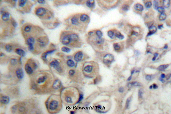 Immunohistochemistry (IHC) analyzes of PLC β3 (L532) pAb in paraffin-embedded human breast carcinoma tissue.