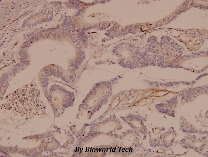 Immunohistochemistry (IHC) analyzes of Ras-GRF1 (F912) pAb in paraffin-embedded human colorectal carcinoma tissue at 1:50.