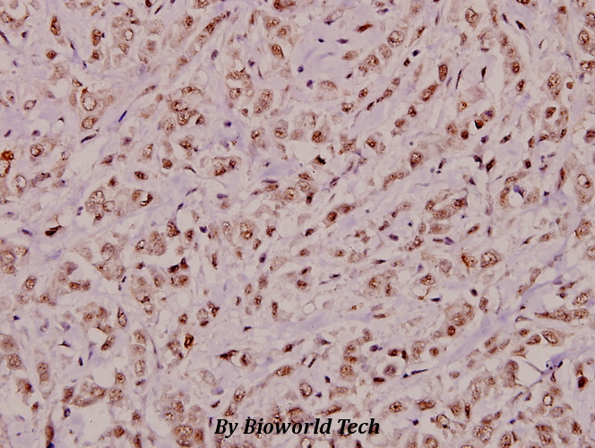 Immunohistochemistry (IHC) analyzes of STAM2 (T188) pAb in paraffin-embedded human breast carcinoma tissue at 1:100.