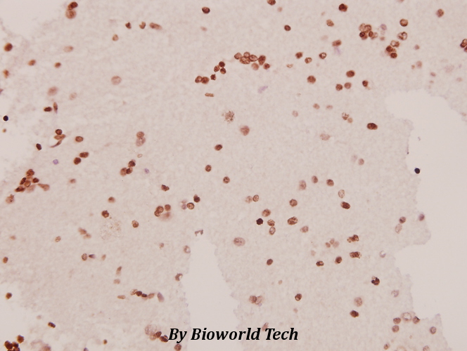 Immunohistochemistry (IHC) analyzes of SAPAP1 (E817) pAb in paraffin-embedded human brain carcinoma tissue at 1:50.