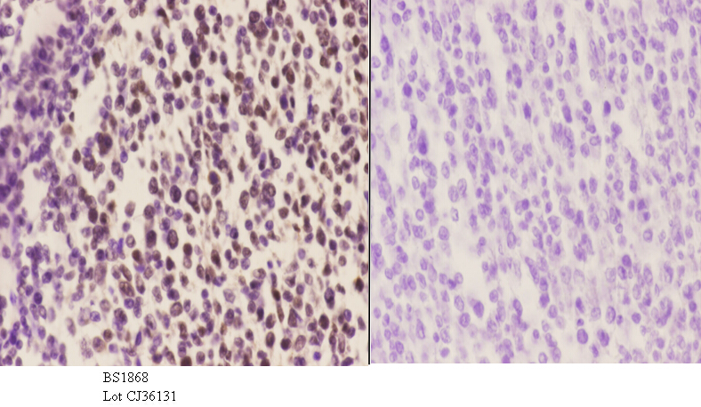 Immunohistochemistry (IHC) analyzes of BACH1 (L160) pAb in paraffin-embedded human tonsil carcinoma tissue at 1:50.showing Nucleus staining. Negative control (the right)Using PBS instead of primary antibody, secondary antibody is Goat Anti-Rabbit IgG-biotin followed by avidin-peroxidase.
