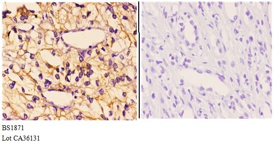 Immunohistochemistry (IHC) analyzes of GAK (Q129) pAb in paraffin-embedded human kidney carcinoma tissue at 1:50.showing Cytoplasm staining. Negative control (the right)Using PBS instead of primary antibody, secondary antibody is Goat Anti-Rabbit IgG-biotin followed by avidin-peroxidase.