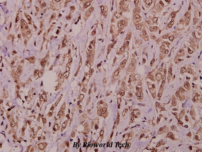 Immunohistochemistry (IHC) analyzes of AKAP 10 (R27) pAb in paraffin-embedded human colorectal carcinoma tissue at 1:50.