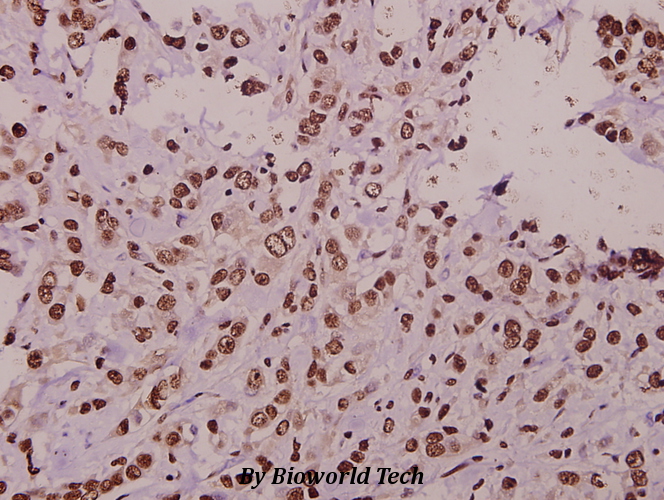 Immunohistochemistry (IHC) analyzes of ST18 (E72) pAb in paraffin-embedded human colorectal carcinoma tissue at 1:50.