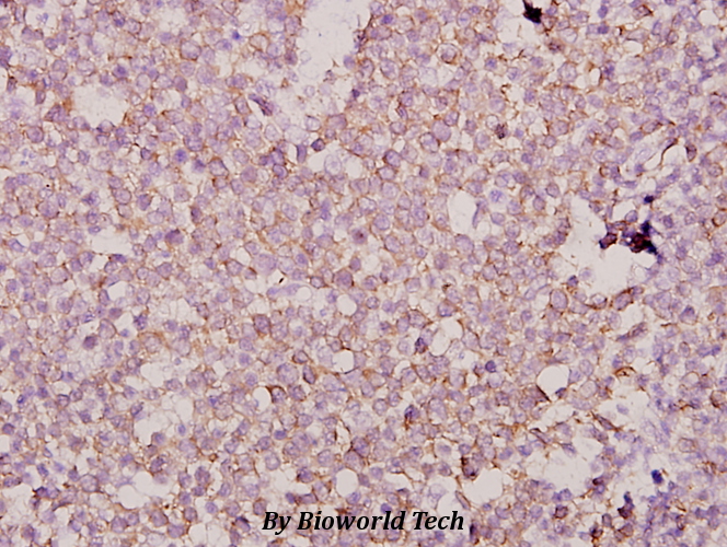 Immunohistochemistry (IHC) analyzes of Dlx-3 (D107) pAb in paraffin-embedded human tonsil carcinoma tissue at 1:50.