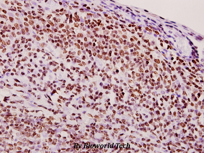 Immunohistochemistry (IHC) analyzes of hnRNP Q (E268) pAb in paraffin-embedded human tonsil carcinoma tissue at 1:50.