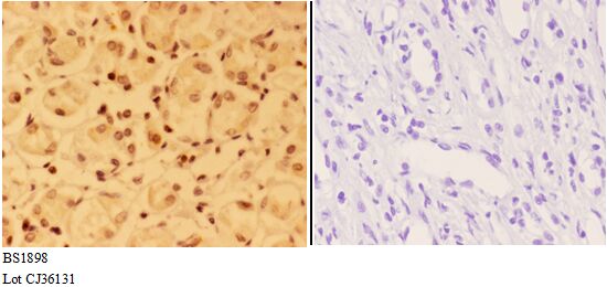 Immunohistochemistry (IHC) analyzes of ALX3 (R203) pAb in paraffin-embedded human kidney carcinoma tissue at 1:50,showing nucleus staining.Negative control (the right)Using PBS instead of primary antibody, secondary antibody is Goat Anti-Rabbit IgG-biotin followed by avidin-peroxidase.