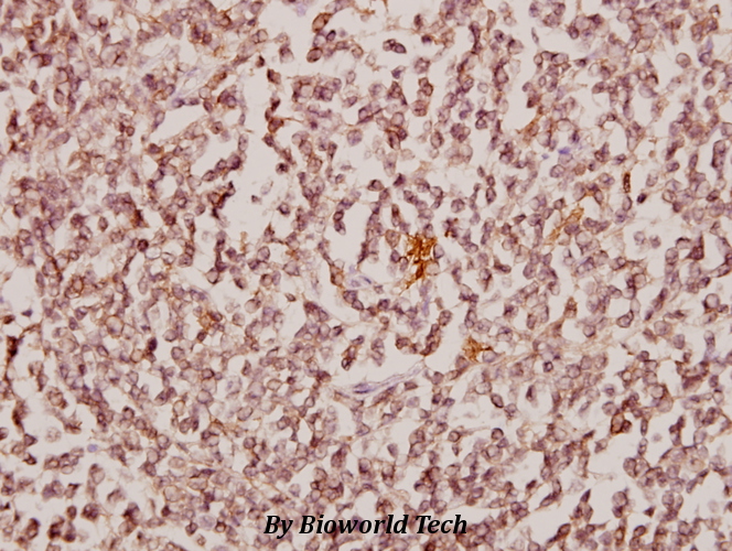 Immunohistochemistry (IHC) analyzes of CBX6 (K18) pAb in paraffin-embedded human tonsil carcinoma tissue at 1:50.
