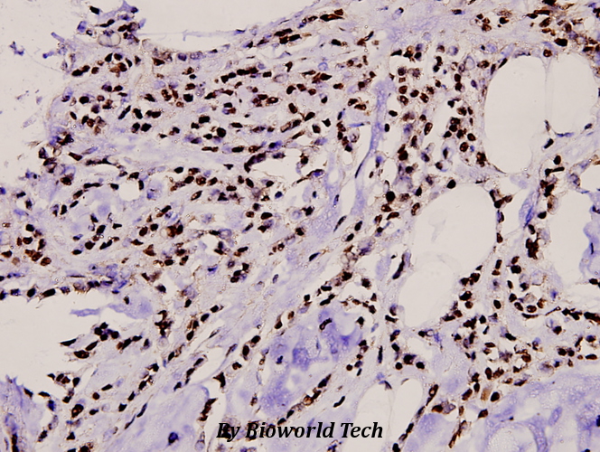 Immunohistochemistry (IHC) analyzes of TBX15/18 (D164) pAb in paraffin-embedded human breast carcinoma tissue at 1:100.