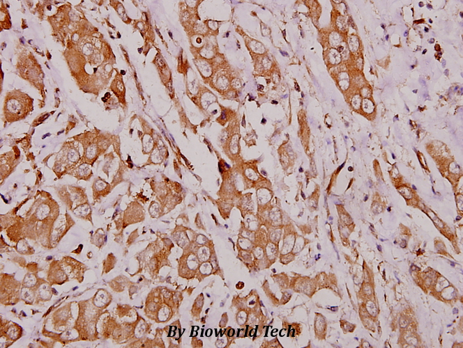 Immunohistochemistry (IHC) analyzes of Hexb (S516) pAb in paraffin-embedded human breast carcinoma tissue at 1:100.