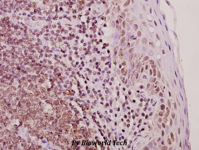 Immunohistochemistry (IHC) analyzes of Hox-C6 (G220) pAb in paraffin-embedded human tonsil carcinoma tissue at 1:50.