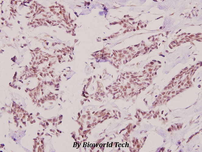 Immunohistochemistry (IHC) analyzes of HKR1 (W154) pAb in paraffin-embedded human breast carcinoma tissue at 1:100.