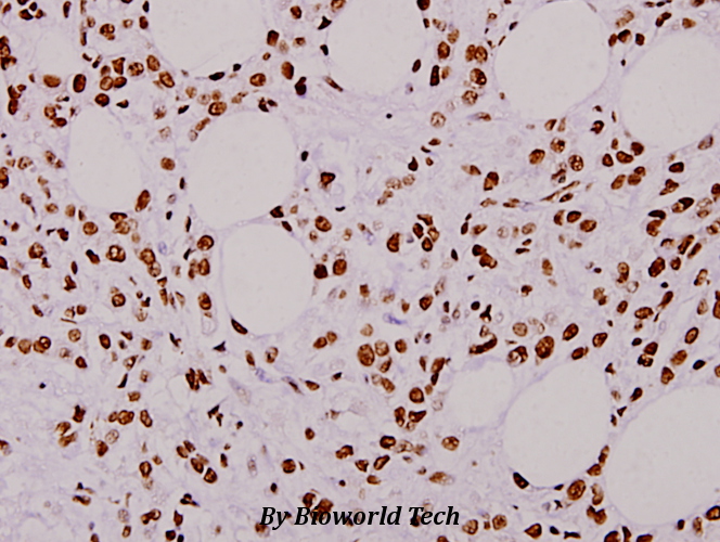 Immunohistochemistry (IHC) analyzes of hnRNP L (G58) pAb in paraffin-embedded human breast carcinoma tissue at 1:100.