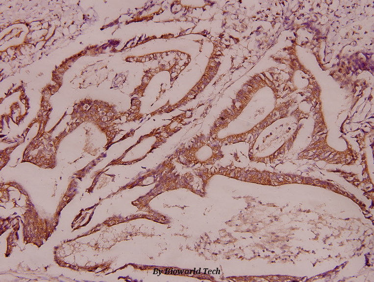 Immunohistochemistry (IHC) analyzes of PITSLRE (K20) pAb in paraffin-embedded human colorectal cancer carcinoma tissue at 1:100.