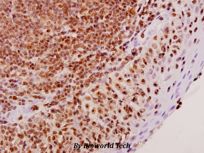 Immunohistochemistry (IHC) analyzes of hnRNP A2/B1 (E11) pAb in paraffin-embedded human tonsil carcinoma tissue at 1:50.