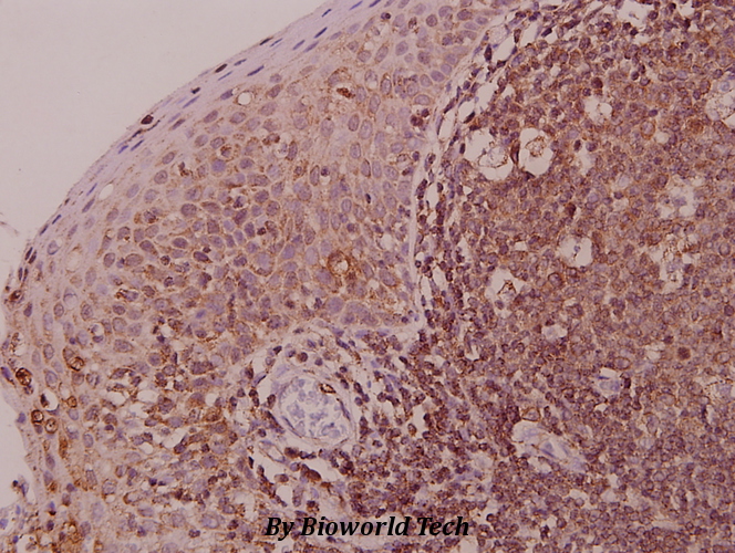 Immunohistochemistry (IHC) analyzes of Myf-6 (R150) pAb in paraffin-embedded human tonsil carcinoma tissue at 1:50.