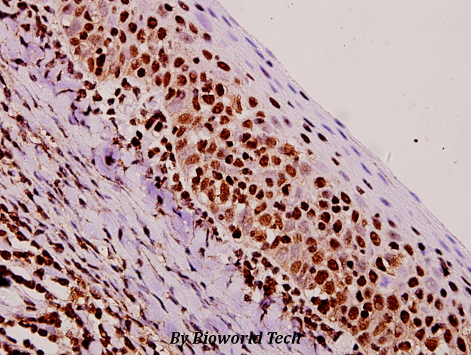 Immunohistochemistry (IHC) analyzes of NF-YA (K290) pAb in paraffin-embedded human tonsil carcinoma tissue at 1:50.