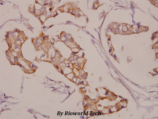 Immunohistochemistry (IHC) analyzes of AKAP 5 (E7) pAb in paraffin-embedded human breast carcinoma tissue at 1:50.