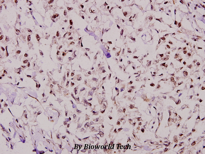 Immunohistochemistry (IHC) analyzes of NF-YB (Q30) pAb in paraffin-embedded human breast carcinoma tissue at 1:100.