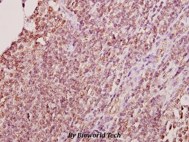 Immunohistochemistry (IHC) analyzes of Hel-N1 (N86) pAb in paraffin-embedded human tonsil carcinoma tissue at 1:50.